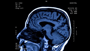 Traumatic Brain Injury (TBI)