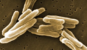 Tuberculosis