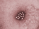 Hepatitis A