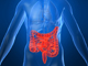 Irritable Bowel Syndrome (IBS)